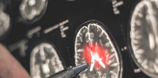 A hand pointing at a brain scan with highlighted areas